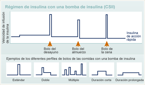 Régimende Insulina con Una bomba de Insulina（CSII）