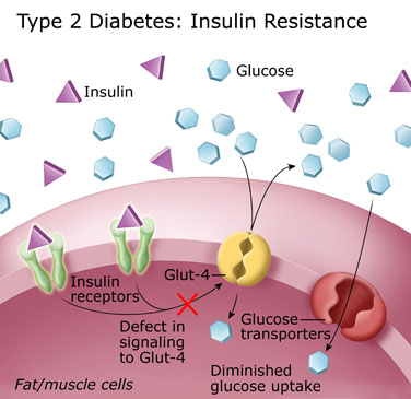 2型糖尿病：胰雷竞技raybet-com岛素抵抗