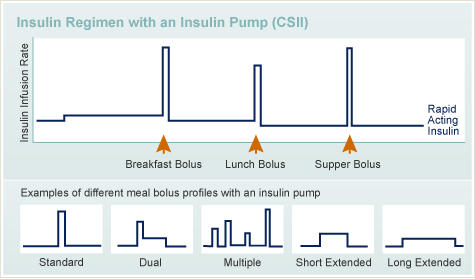 胰岛素泵（CSII）的胰岛素方案